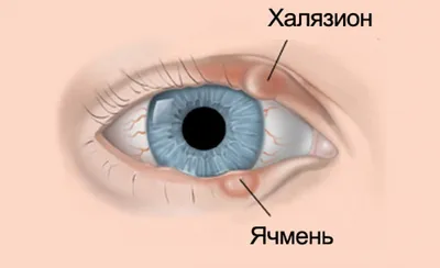 Что такое халязион, отличия от ячменя и как его лечить