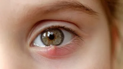 Ячмень на глазу. Ребенок с ячмень на глазу. Воспаление века. Человеческое  болезнь Стоковое Фото - изображение насчитывающей кожа, заболевание:  183516306