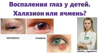 Как избавиться от ячменя на глазу раз и навсегда?👁 - YouTube