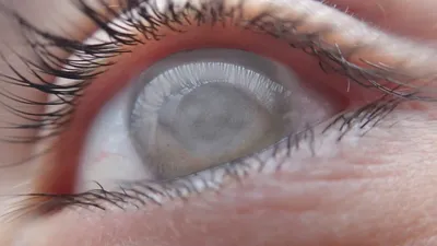 Катаракта - симптомы и лечение лазером - профилактика начинающейся ядерной катаракты  глаза