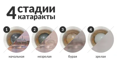 Катаракта - симптомы и лечение лазером - профилактика начинающейся ядерной катаракты  глаза