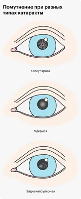 Как связаны между собой катаракта и астигматизм? - Центр Хирургии Глаза