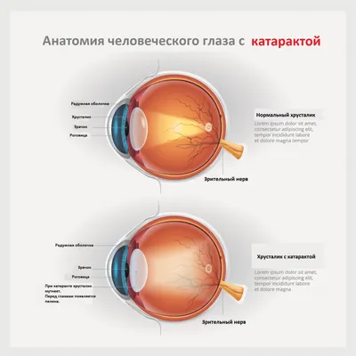 Катаракта: симптомы, причины, лечение, операция по удалению, замена  хрусталика глаза