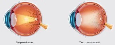 Просто о сложном: что такое катаракта, как лечить катаракту? | Микрохирургия