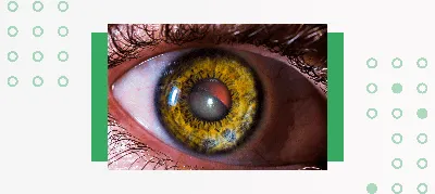 Катаракта симптомы и причины возникновения. Виды и стадии катаракты глаза
