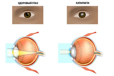 Что такое катаракта? | Блог