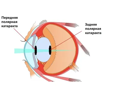 Рис. 2. Глаз пациентки М. спустя 7 лет после операции по удалению ката…