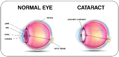Восстановление зрения после замены хрусталика глаза при катаракте -  энциклопедия Ochkov.net