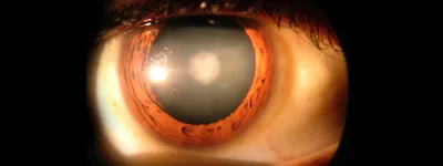 Модифицированная тоннельная экстракция в хирургии осложненных катаракт |  Оренбуркина О.И. | «РМЖ» №1 от 02.04.2008