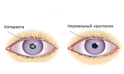 Вікова катаракта – що це, причини, симптоми та лікування | Блог | GlazGo