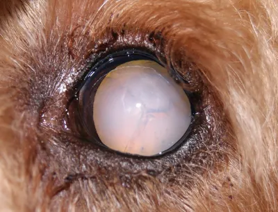 Ядерная катаракта глаз, лечение ядерной катаракты.