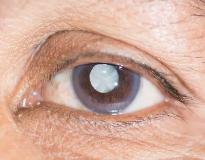 Старческая катаракта - лечение, операция, сдадии