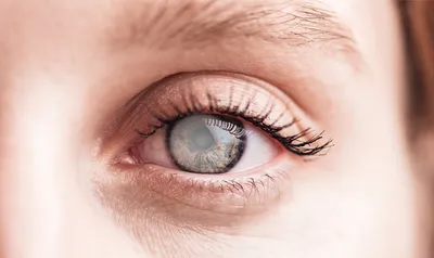 Что нельзя делать после операции по удалению катаракты | блог Хирургия глаза