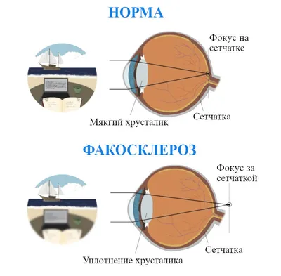 Симптомы катаракты, профилактика и лечение