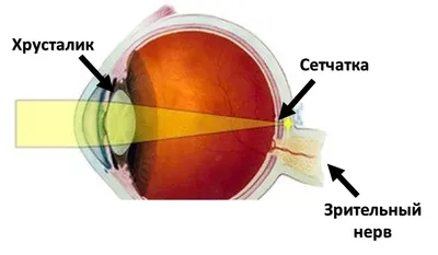 Факосклероз хрусталика обоих глаз - что это и как лечить