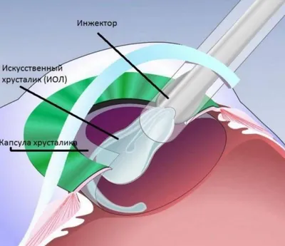 Способы замены хрусталика при катаракте - энциклопедия Ochkov.net