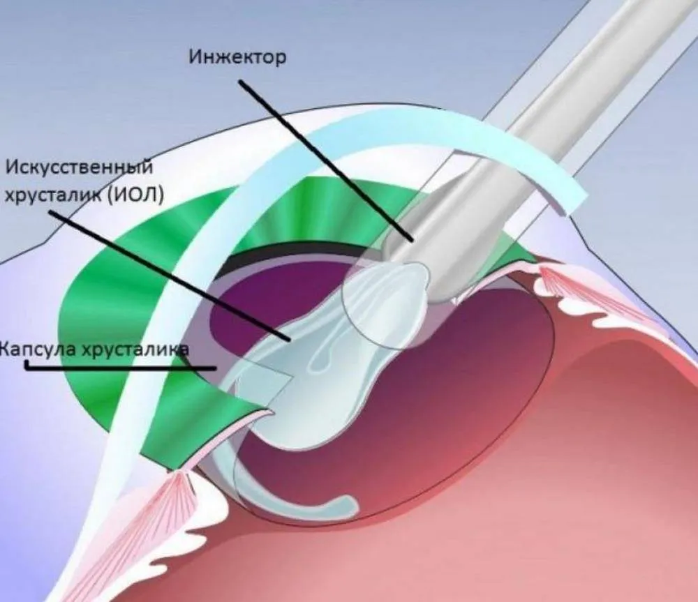 Операция факоэмульсификация катаракты