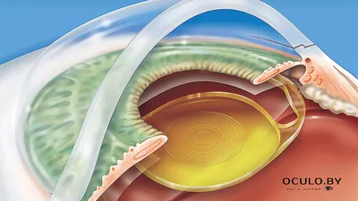 Операция по замене хрусталика глаза