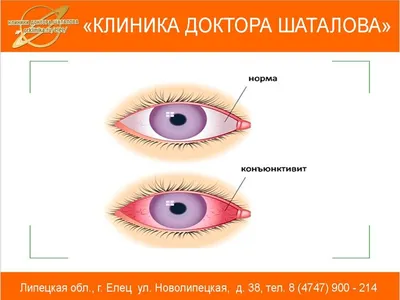 Конъюнктивит у взрослых: причины, симптомы, лечение, профилактика в  домашних условиях