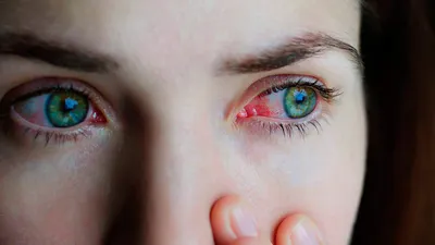 Сухость глаз, или «сухой конъюнктивит» − это комплекс патологических  признаков, развивающийся в связи с недостаточным увлажнением💧… | Instagram