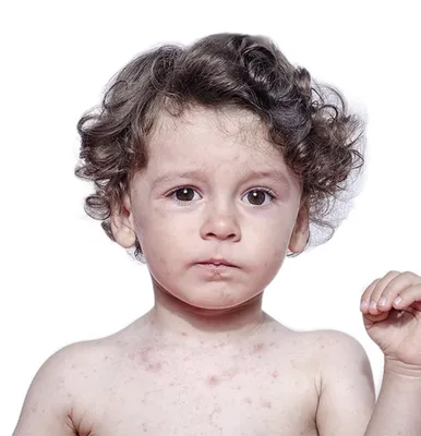 Инфекция кори - чем она опасна для детей | Педиатр и Я | Дзен