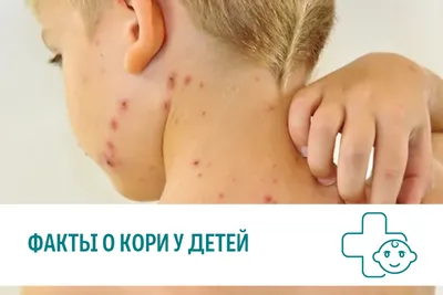 Необоснованные медотводы подвергли риску жизни детей – врач о вспышке кори  в Казахстане