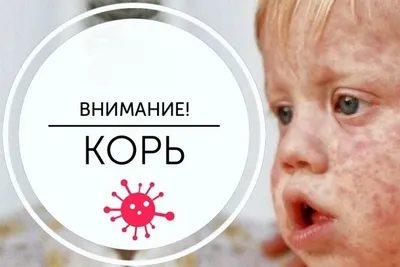 Вспышка кори в России: что нужно знать о болезни, симптомы, профилактика,  лечение