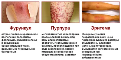 Сыпь на теле: причины высыпаний на коже, виды, симптомы, диагностика и  лечение