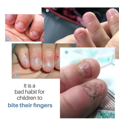 Почему ребенок грызет ногти: причины, что делать если ребенок грызет ногти  - советы психолога