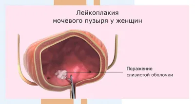 Лейкоплакия мочевого пузыря: симптомы, диагностика и лечение у женщин