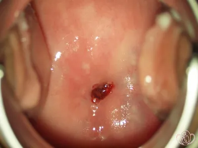 Местное лечение эрозивно-язвенных поражений слизистой оболочки полости рта  - DENTALMAGAZINE.RU