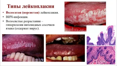 Лейкоплакия мочевого пузыря: причины, симптомы, методы лечения и операции у  женщин и мужчин