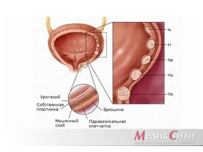 Лейкоплакия лечение и симптомы в медицинском центре ID-CLINIC  Санкт-Петербург