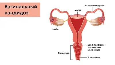 Молочница во рту (кандидоз) – у детей и взрослых, симптомы, причины, лечение