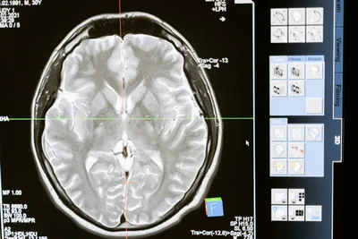 МРТ головного мозга - цена в Москве, сделать магнитно-резонансную  томографию головы в «СМ-Клиника»