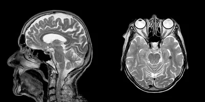 Что такое МРТ головного мозга? | МРТ-Експерт