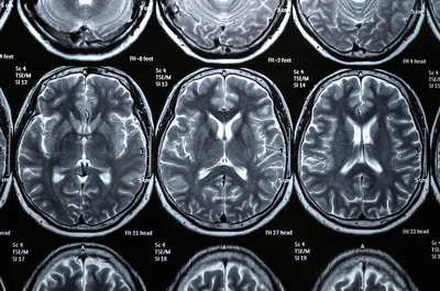 МРТ головного мозга ребенку