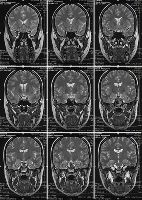 МРТ головного мозга в Купчино