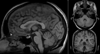 Опухоль на МРТ головного мозга - что покажет, признаки, фото