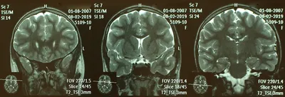 МРТ головного мозга Киев, Винница цена – МРТ головы и мозга с контрастом и  без 1,5 и 3 Тесла