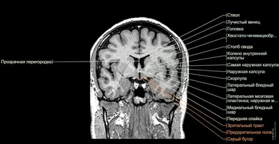 Магнитно-резонансной томографии головного мозга | Медцентр Авиценна