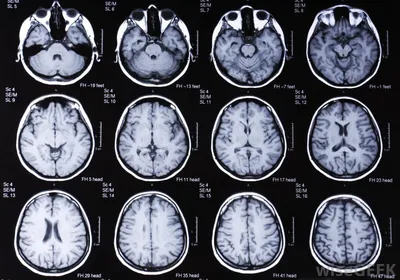 МРТ головного мозга + МРТ орбит в СПб – цена 6600 руб в центре МРТ  диагностики «Доступная медицина»