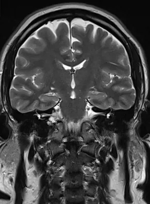 МРТ головного мозга при эпилепсии в Алматы: цена, запись - ExpertNeuro