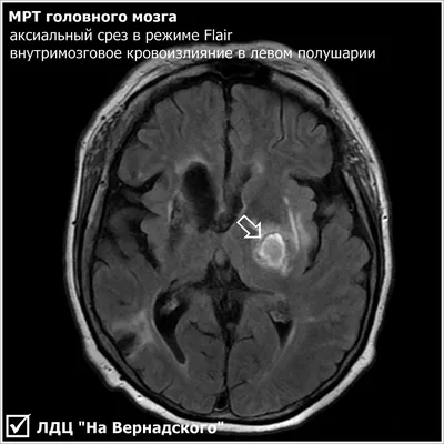 МРТ головного мозга в Санкт-Петербурге с контрастом - цены, запись на  платное обследование головного мозга\"