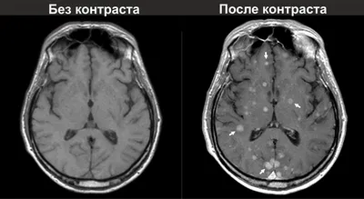 МРТ головного мозга: что показывает, суть метода, когда назначают?