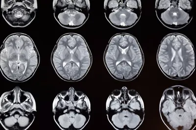 Опухоль на МРТ головного мозга - что покажет, признаки, фото
