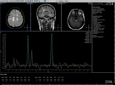 МРТ головного мозга при эпилепсии в Новосибирске – цены в клинике «МРТ  Альянс»