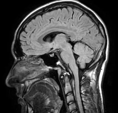 МРТ сосудов головного мозга: что это, показания и противопоказания |  Клиника Эксперт