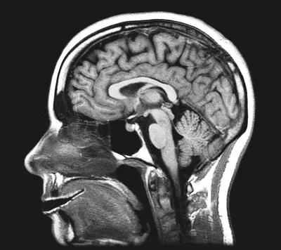 Головной мозг МРТ : нормальная анатомия | e-Anatomy