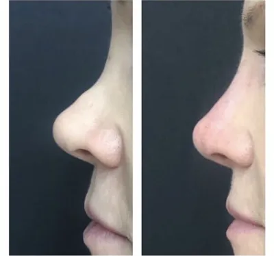 Ринопластика носа | Александр Катков